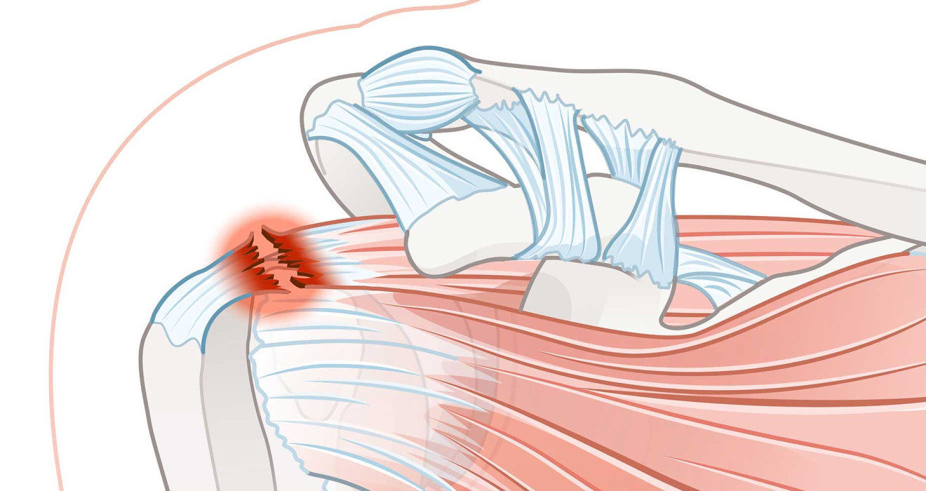 Omuz (Rotator Cuff) Yırtıkları